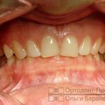 deep bite, TMJ dysfunction