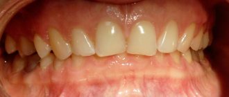 deep bite, TMJ dysfunction