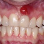 Гнойник во рту сверху