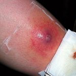 purulent inflammation