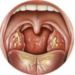 гнойный тонзилит - признаки