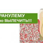 tooth root granuloma