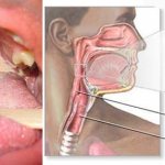Грибок в горле: что это? Как лечить у взрослых и детей. Фото