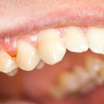 хронический фиброзный периодонтит - описание заболевания