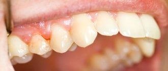chronic fibrous periodontitis - description of the disease