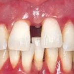 Chronic generalized periodontitis: causes, diagnosis, treatment methods