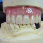 immediate prosthesis reviews