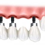 Имплант или мост - что лучше?