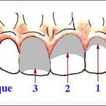 green vermilion index