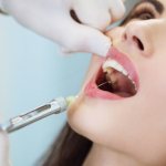 инфильтрационная анестезия в стоматологии методика проведения