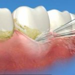 irrigator waterpik 100