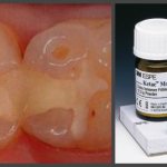 Использование цементных порошков в стоматологии