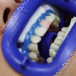 Использование геля Клокс для отбеливания