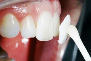 Использование люминиров в стоматологии