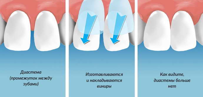 исправление кривых зубов керамическими винирами