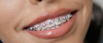 Correcting malocclusion