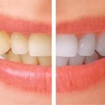 Изменение цвета зубов: в чем причина?