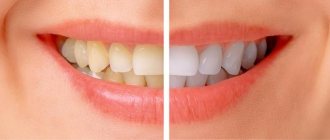 Changing the color of teeth: what is the reason?