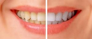 Изменение цвета зубов: в чем причина?