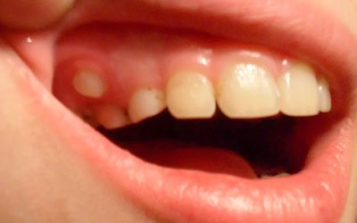 К чему приводит «акулья» улыбка - Стоматология Линия Улыбки