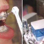 how to clean braces