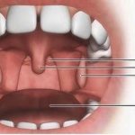 Как чистят миндалины. Мы чистим миндалины и не болеем.