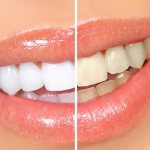 How to use teeth whitening gel