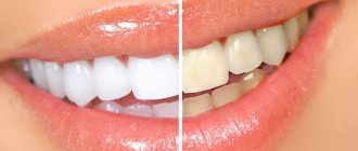 Как использовать гель для отбеливания зубов