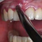 Как не допустить образования свища после имплантации зубов