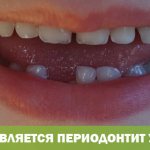 Как проявляется периодонтит у ребенка