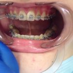 Как снять брекет с дуги который отклеился стоимость