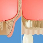 how to remove filling material from the maxillary sinus
