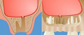 how to remove filling material from the maxillary sinus