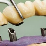 How telescopic dentures work