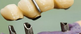 Как устроены телескопические зубные протезы