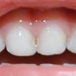 Как выглядит кариес между передними зубами