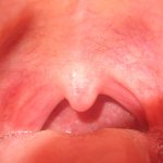 Как выглядит здоровое и больное красное горло у ребенка, какими в норме должны быть миндалины?