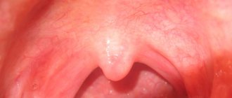 What does a healthy and sick red throat look like in a child, what should tonsils normally look like?