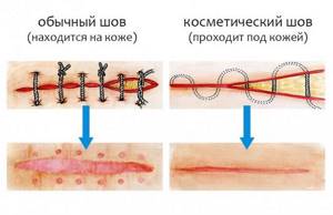 Как зашить рану: виды швов