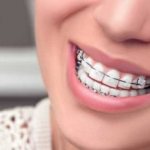 What are the advantages of combined braces?