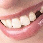 What are the consequences of losing a tooth?