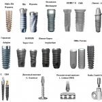 Какой имплант лучше поставить на жевательные зубы