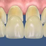 Какой метод препарирования зуба под винир самый лучший