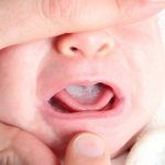 Кандидоз ротовой полости