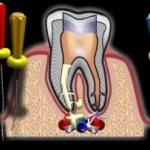 Кариес цемента - лечить или удалять зуб