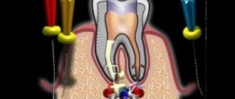 Кариес цемента - лечить или удалять зуб