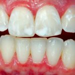 Кариес на стадии пятна