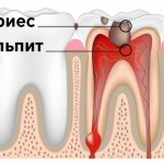 кариес пульпит 4