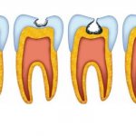 Кариес зубов и его классификация по Блэку