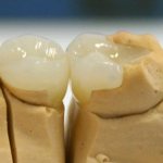 Керамическая вкладка